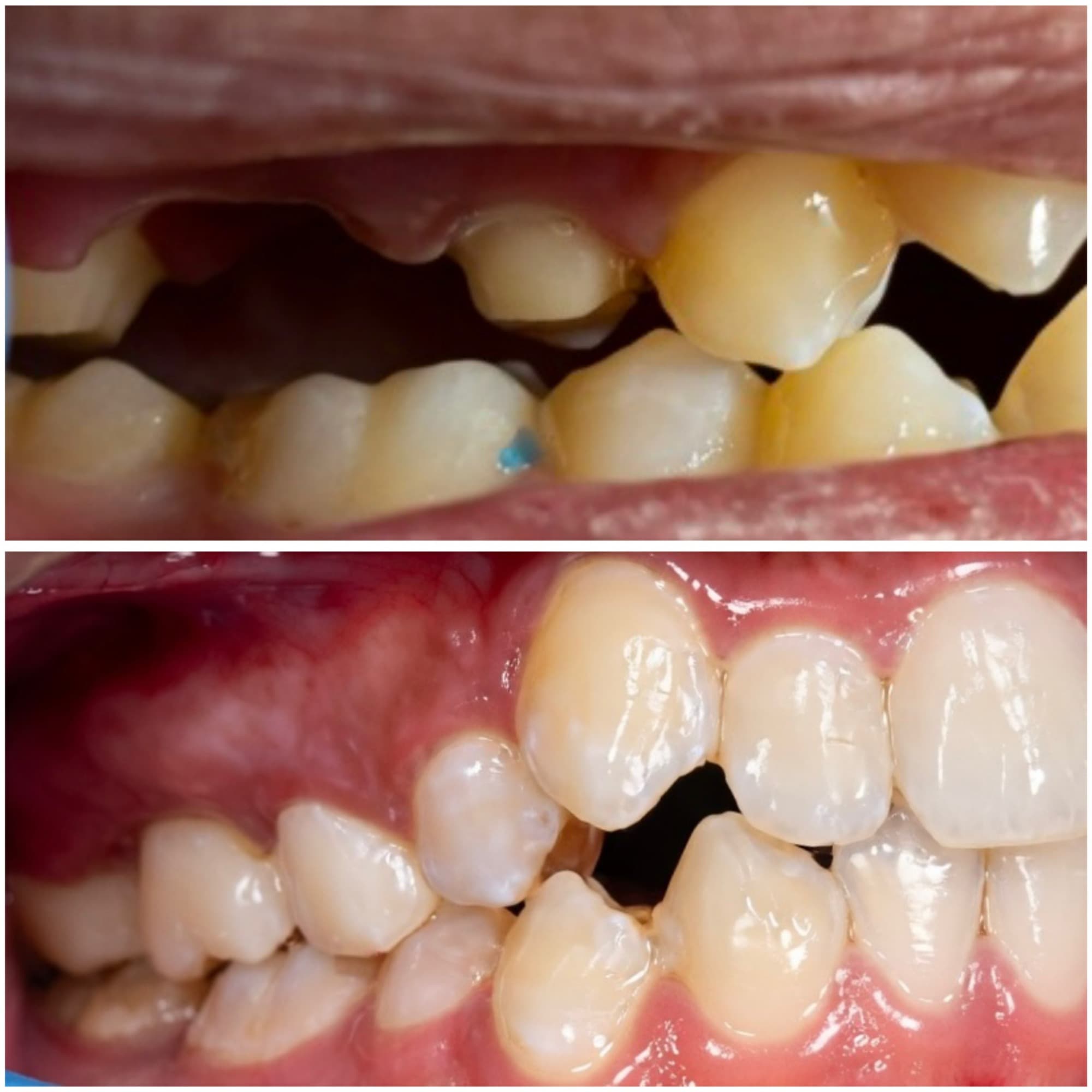 Two side-view intraoral photos: missing upper teeth above, and the same view after the gaps were filled with tooth-coloured restorations