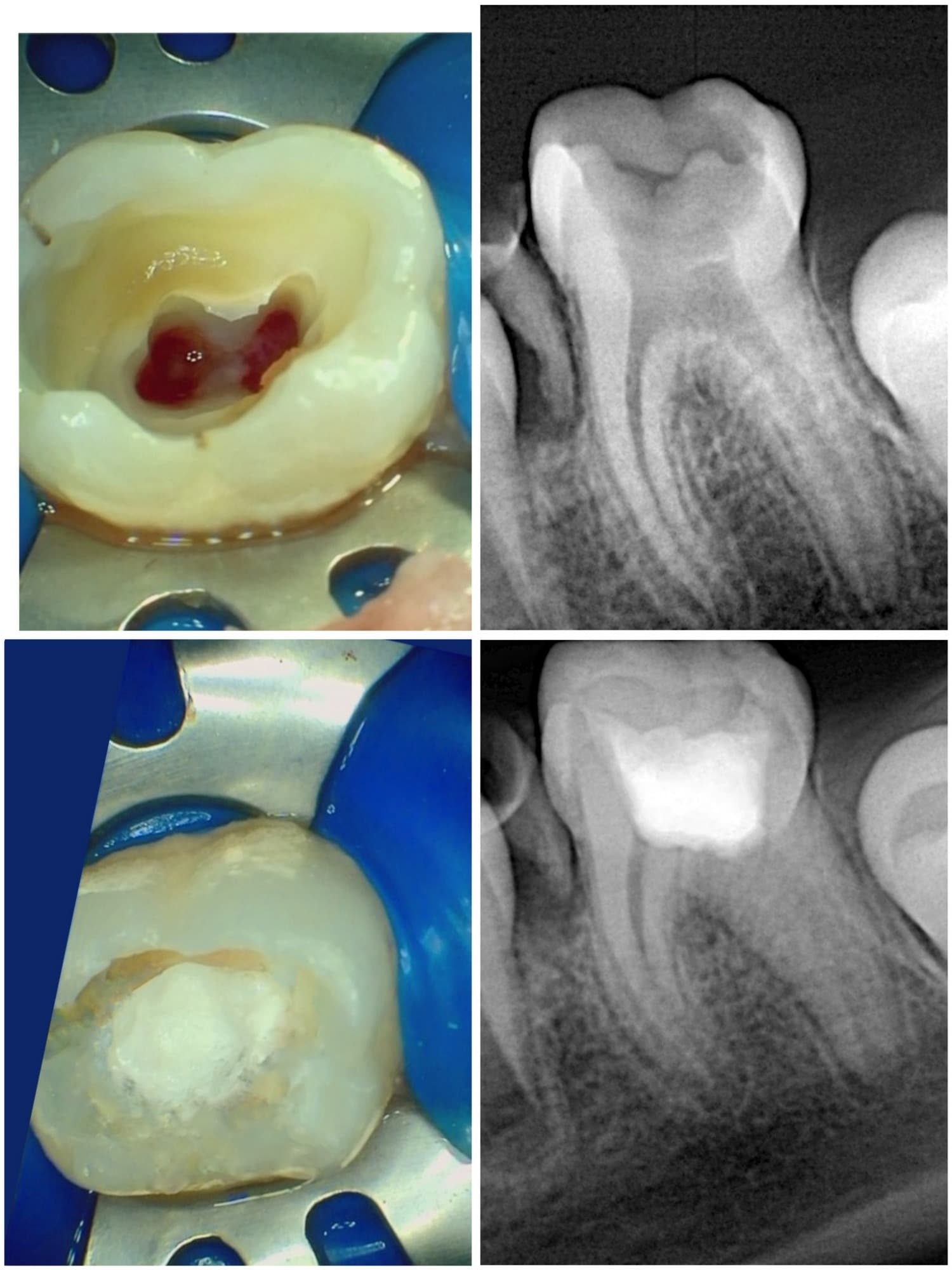 A molar isolated with a rubber dam, shown opened then sealed with a white filling, beside before-and-after radiographs