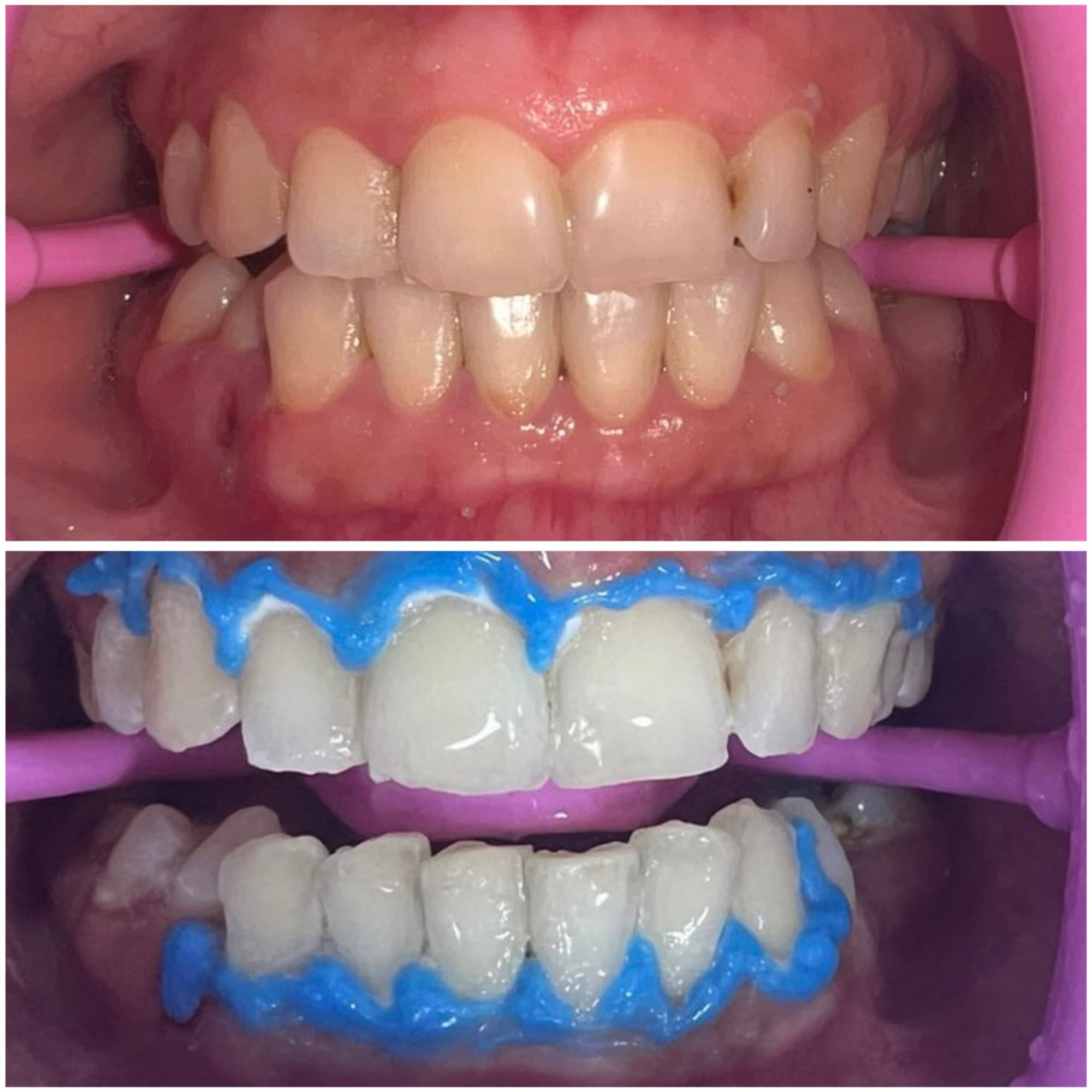Front teeth in pink retractors: the upper view without gel, the lower view with a blue gum barrier and a white layer on the teeth