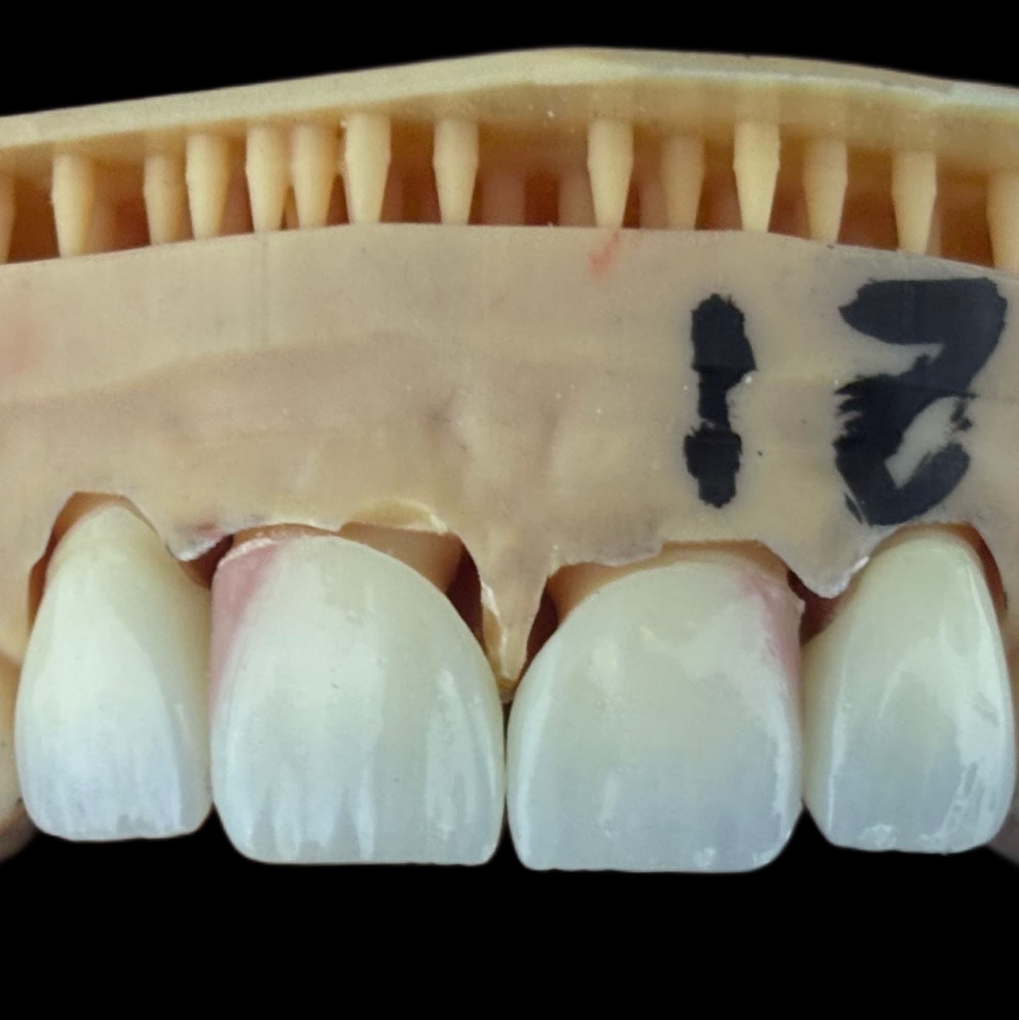Dental stone model showing four white anterior restorations on the upper teeth