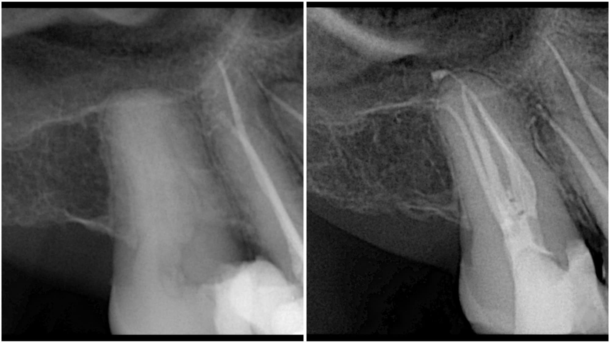 Two dental radiographs of a tooth: the root canals appear darker in the first, and filled with white radiopaque material in the second
