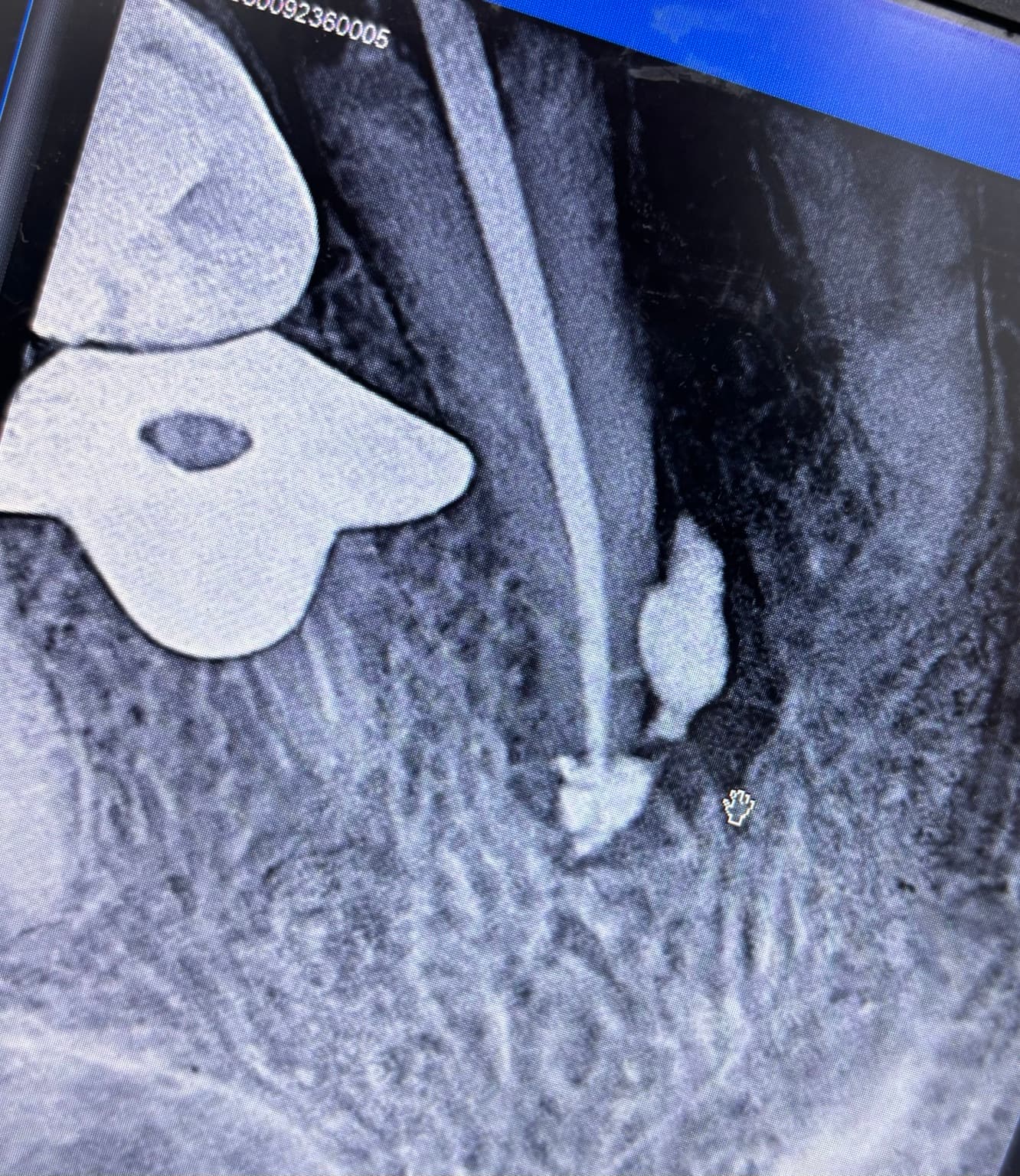 A dental radiograph of a root after the canal was filled, with a metal clamp visible beside the tooth