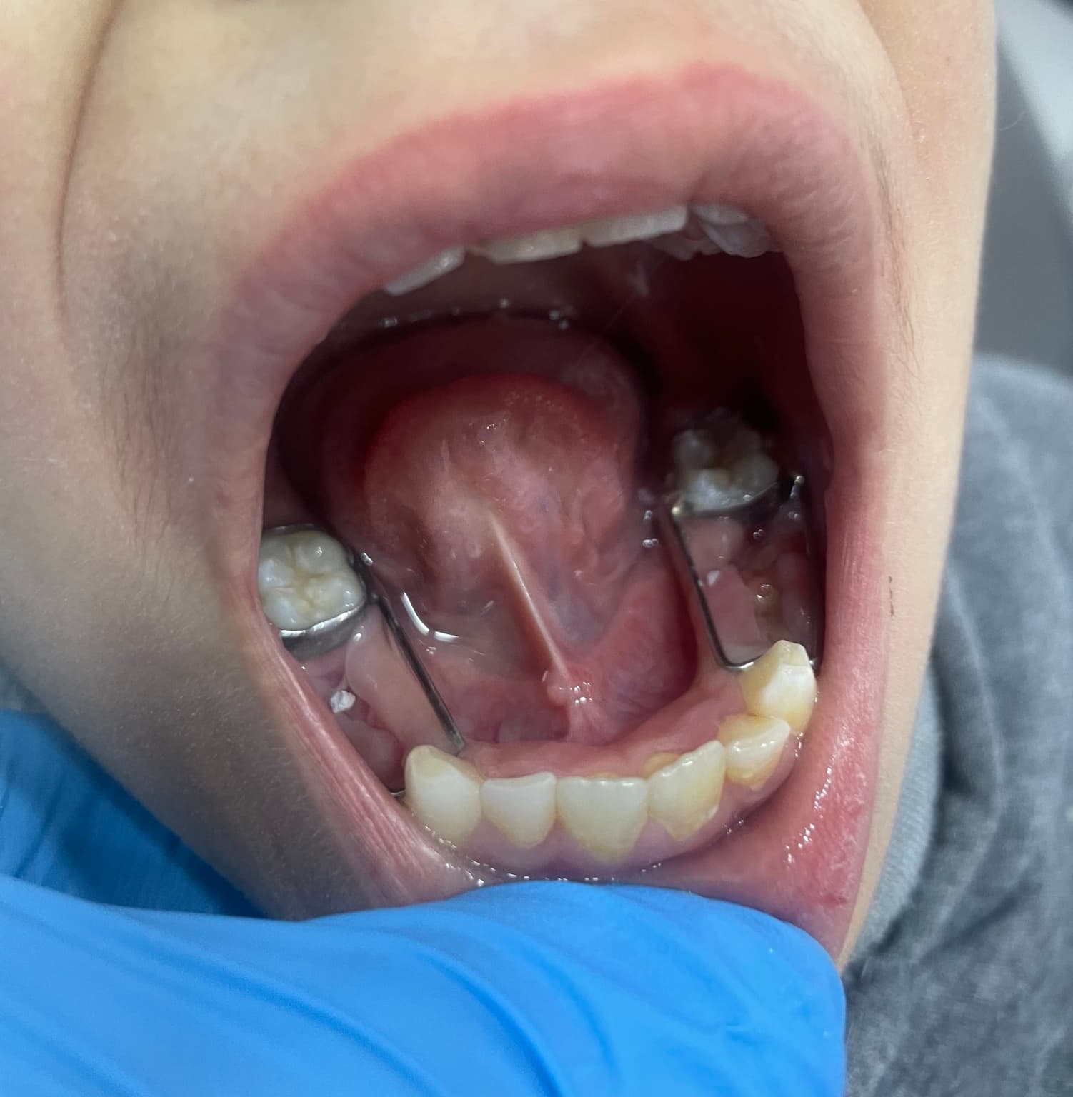 A child’s lower teeth with two metal band-and-loop space maintainers on either side