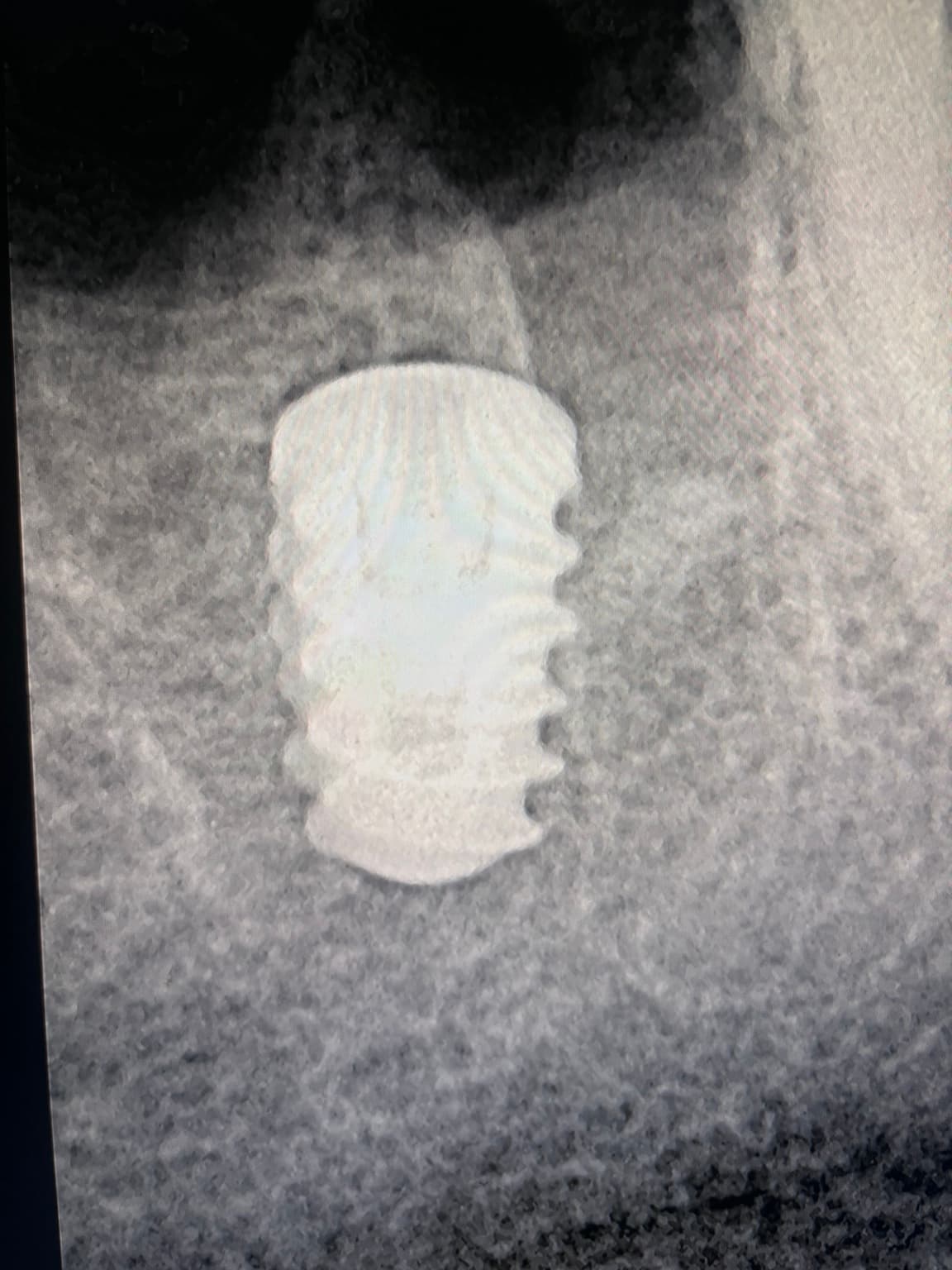 A dental radiograph of a threaded implant placed in the jawbone