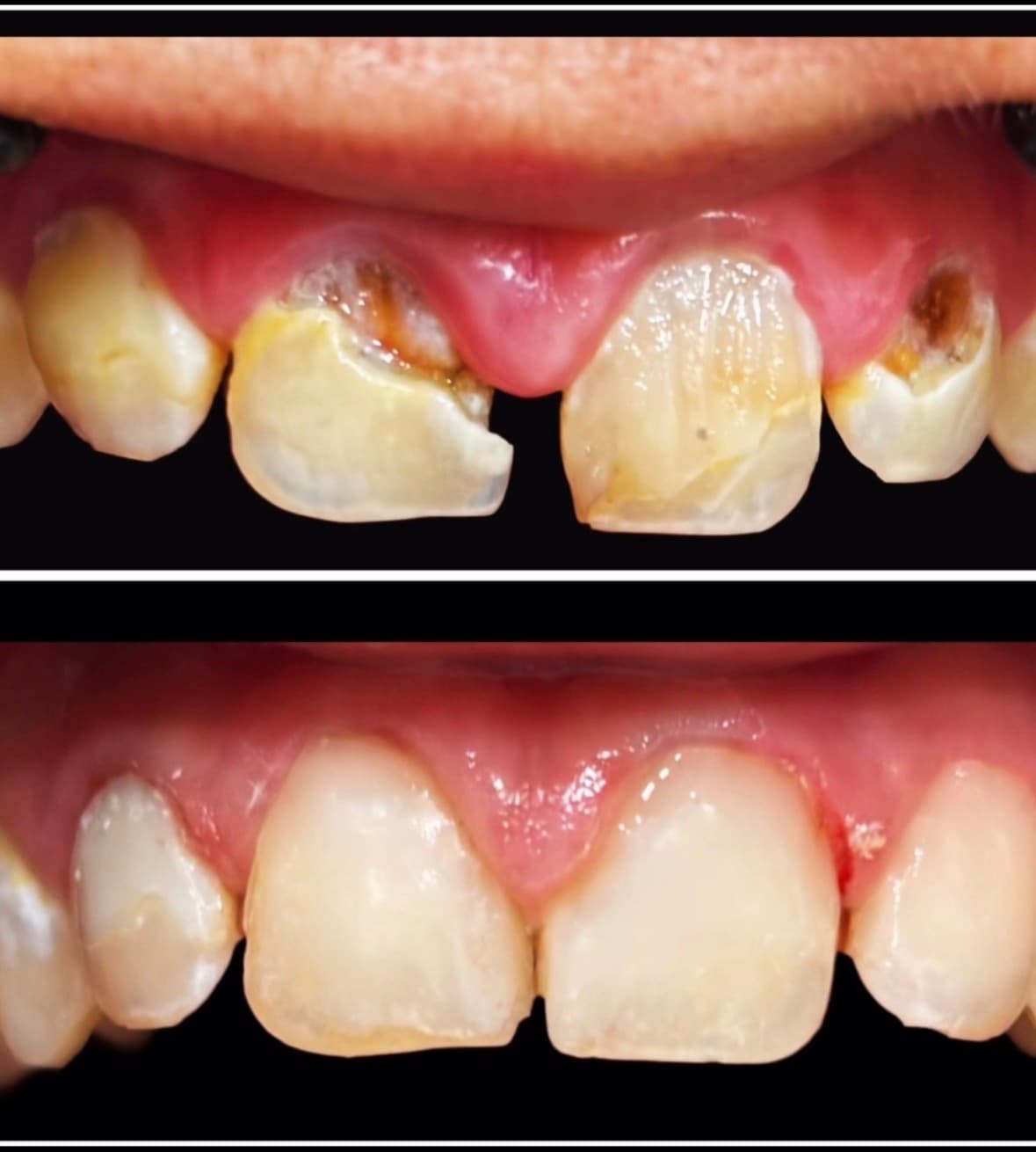 Upper front teeth before and after: decay and staining near the gums above, and tooth-coloured restorations below