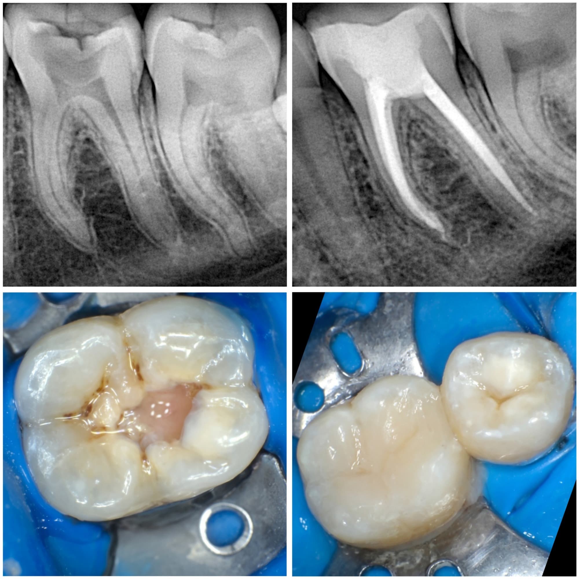 Four views of a molar: radiographs and clinical photos before and after the canals were filled, including rubber-dam isolation and the restored tooth Four views of a molar: radiographs and clinical photos before and after the canals were filled, including rubber-dam isolation and the restored tooth