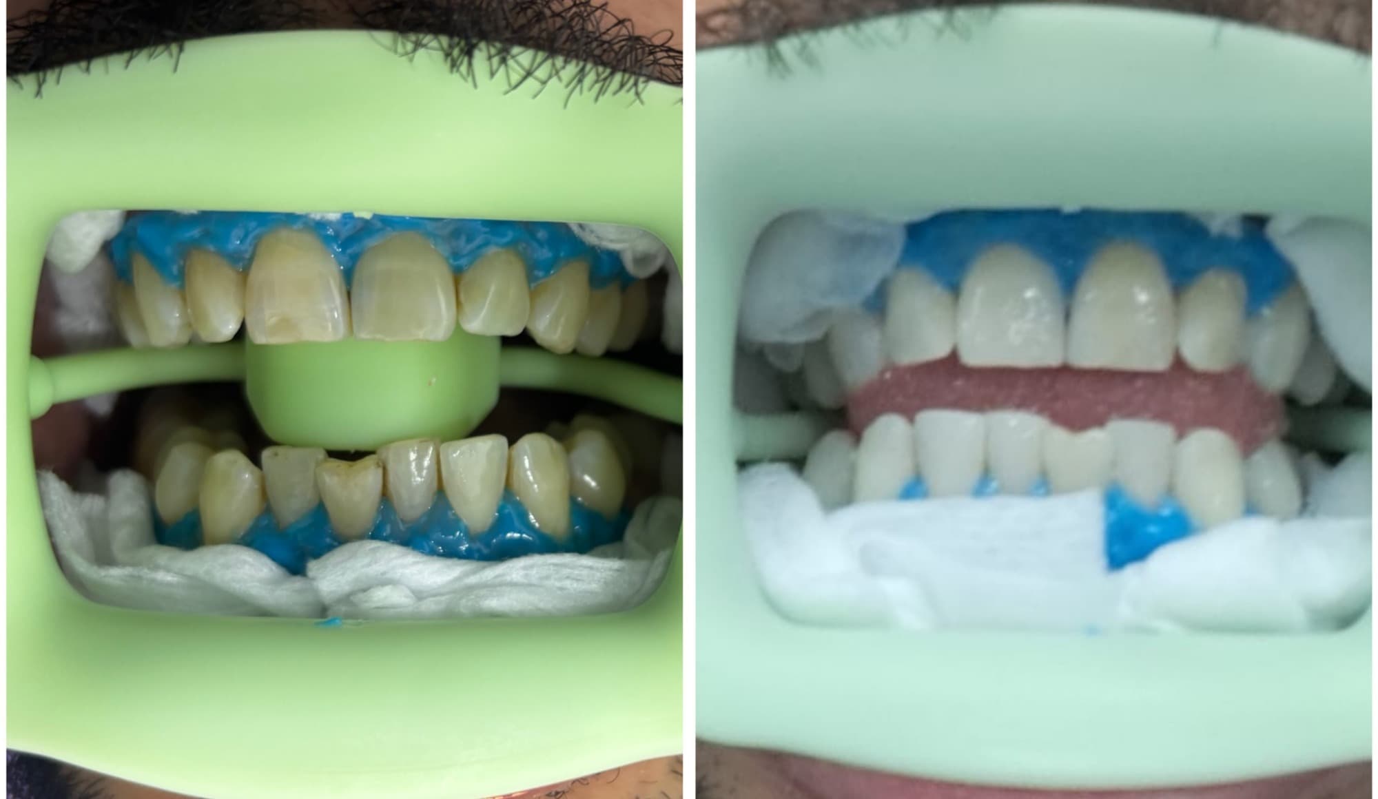 Front teeth held with cheek retractors and a blue gum barrier: a darker shade on the left and a lighter shade on the right Front teeth held with cheek retractors and a blue gum barrier: a darker shade on the left and a lighter shade on the right