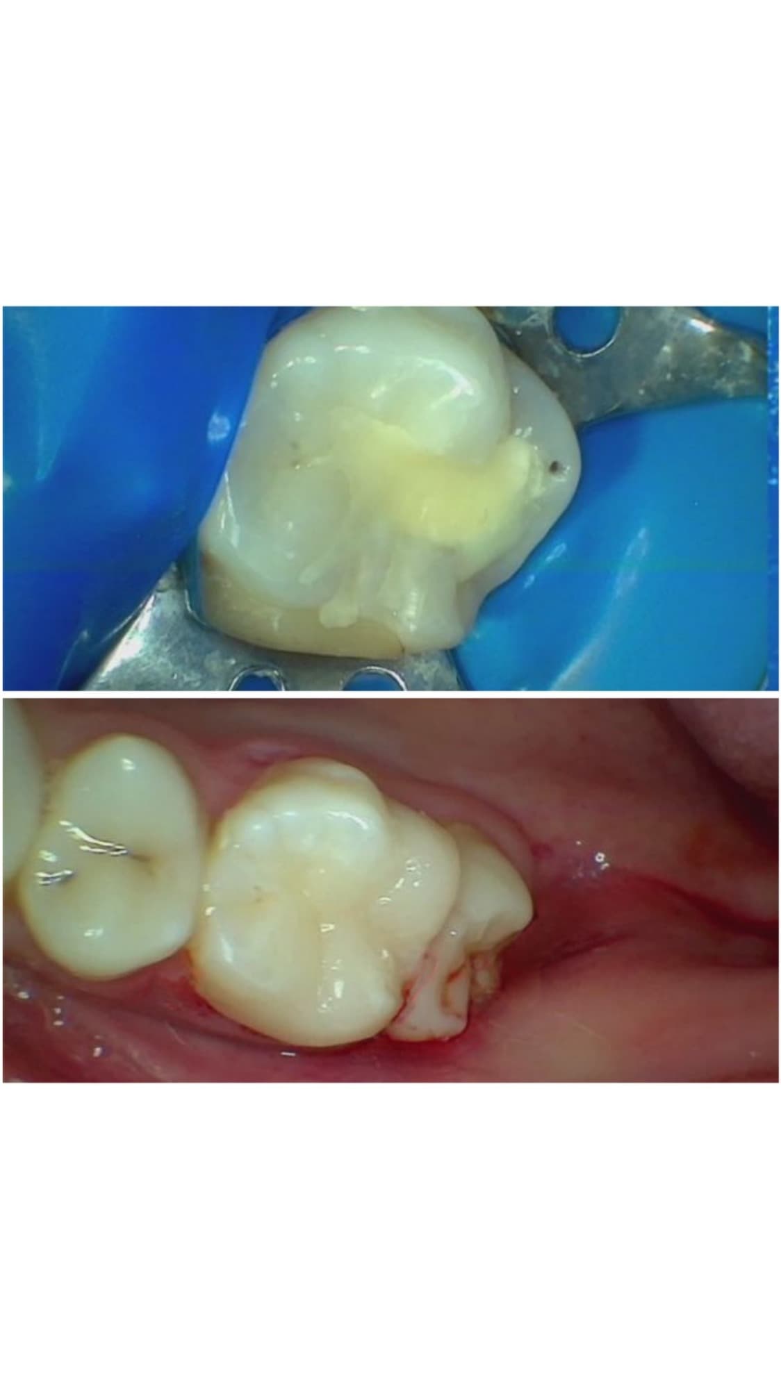 A molar isolated with a rubber dam during restoration, then after a tooth-coloured filling A molar isolated with a rubber dam during restoration, then after a tooth-coloured filling