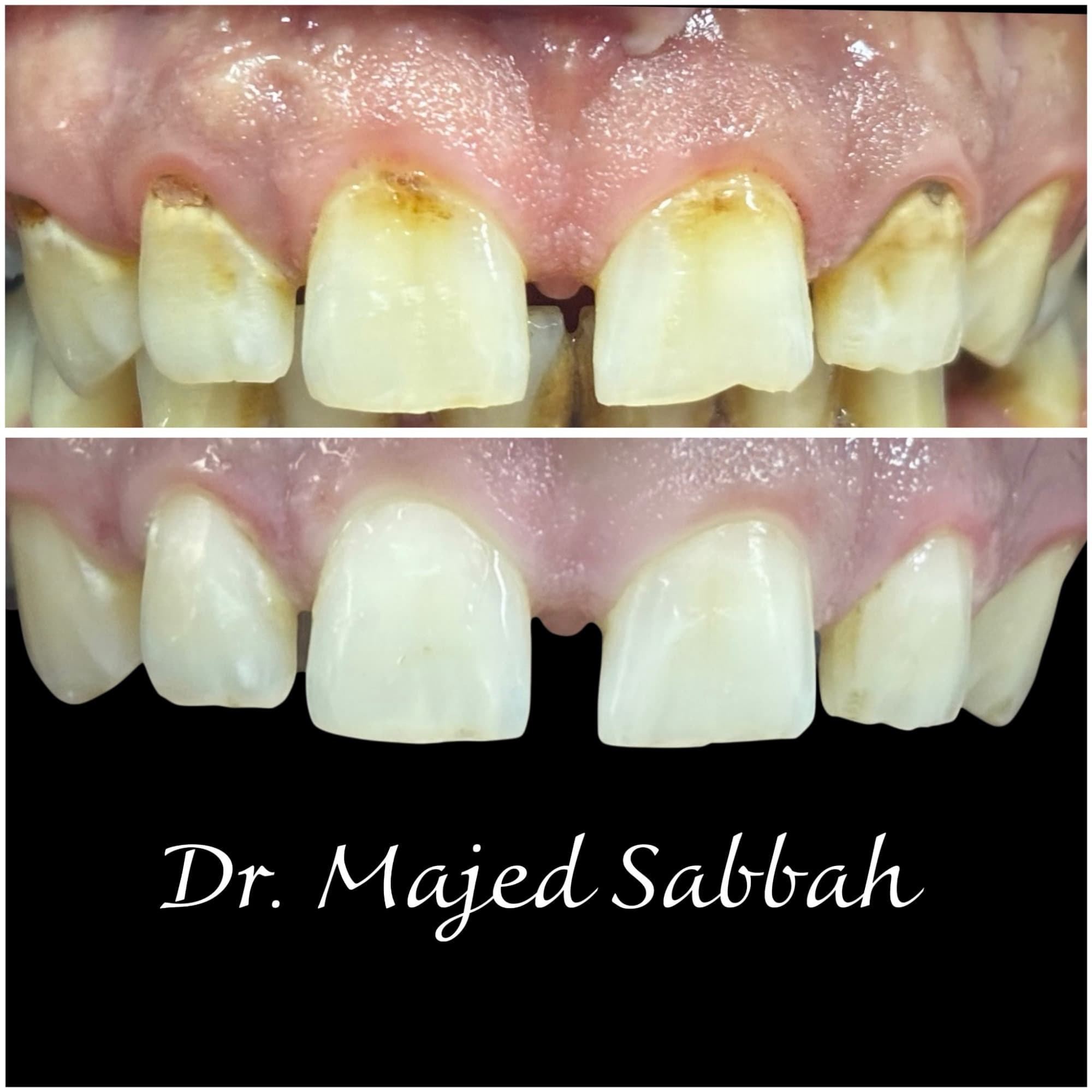 Upper front teeth before and after: dark staining near the gums above, and cleaner, lighter tooth surfaces below Upper front teeth before and after: dark staining near the gums above, and cleaner, lighter tooth surfaces below