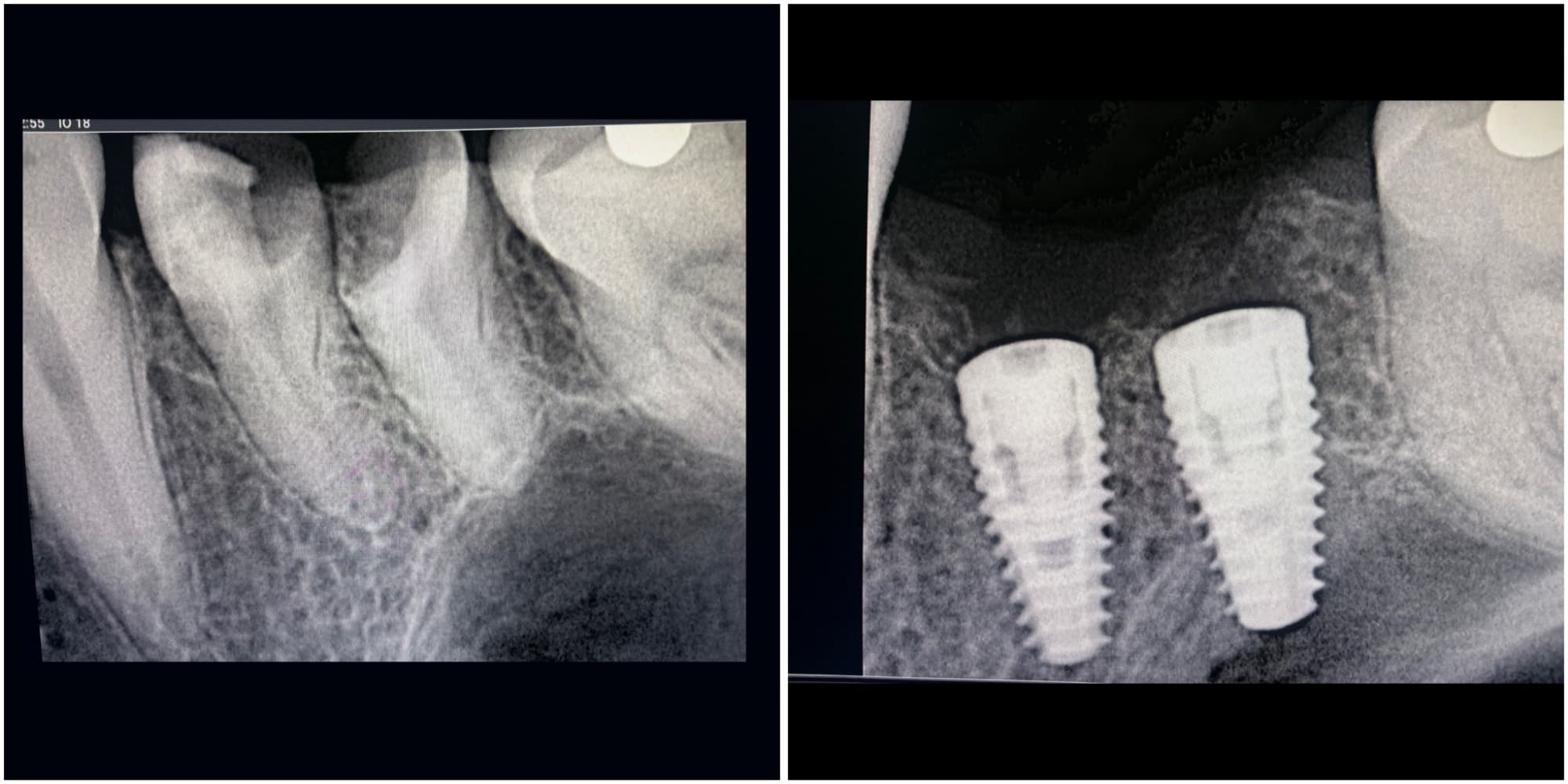 Before-and-after dental radiographs: natural teeth on the left, and two implants placed in the jawbone on the right Before-and-after dental radiographs: natural teeth on the left, and two implants placed in the jawbone on the right
