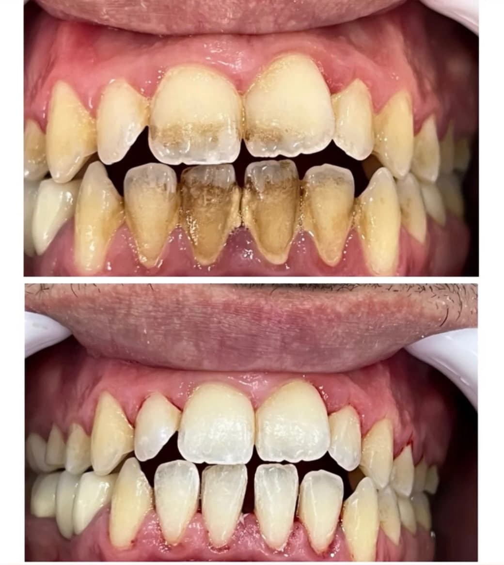 Lower front teeth before and after: dark deposits above, and the same teeth after the deposits were removed Lower front teeth before and after: dark deposits above, and the same teeth after the deposits were removed
