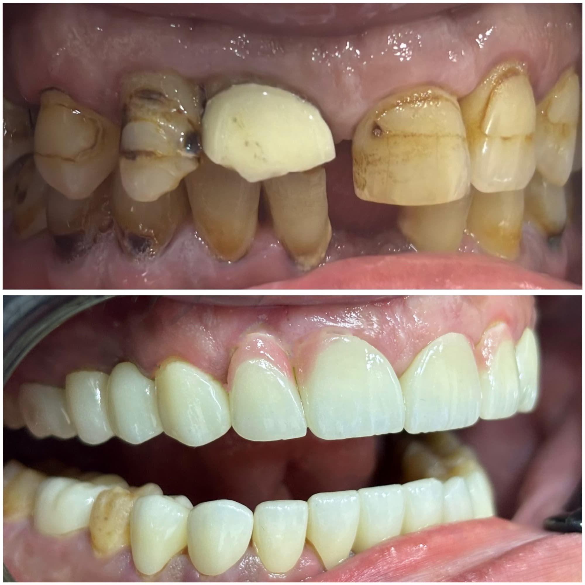 Front teeth before and after: decay, gaps, and an unmatched restoration above; even, lighter restorations below Front teeth before and after: decay, gaps, and an unmatched restoration above; even, lighter restorations below
